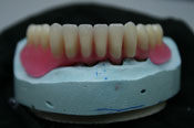 Зубной (дентальный) имплантат