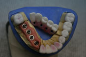 Зубной (дентальный) имплантат