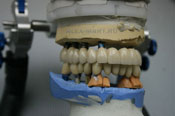 Имплантант имланты керамика зубы лаборатория.