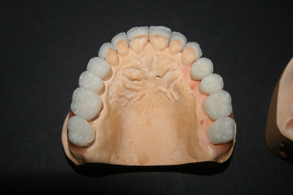 WAX - UP Диагностическое моделирование зубов из воска.