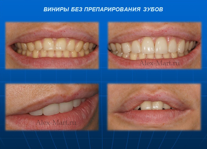 Виниры на зубы керамические, люминиры фарфоровые композитные, Стоимость виниров цена в Москве красивая голливудская улыбка Smile.