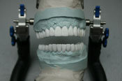 WAX UP Моделирование зубов из воска